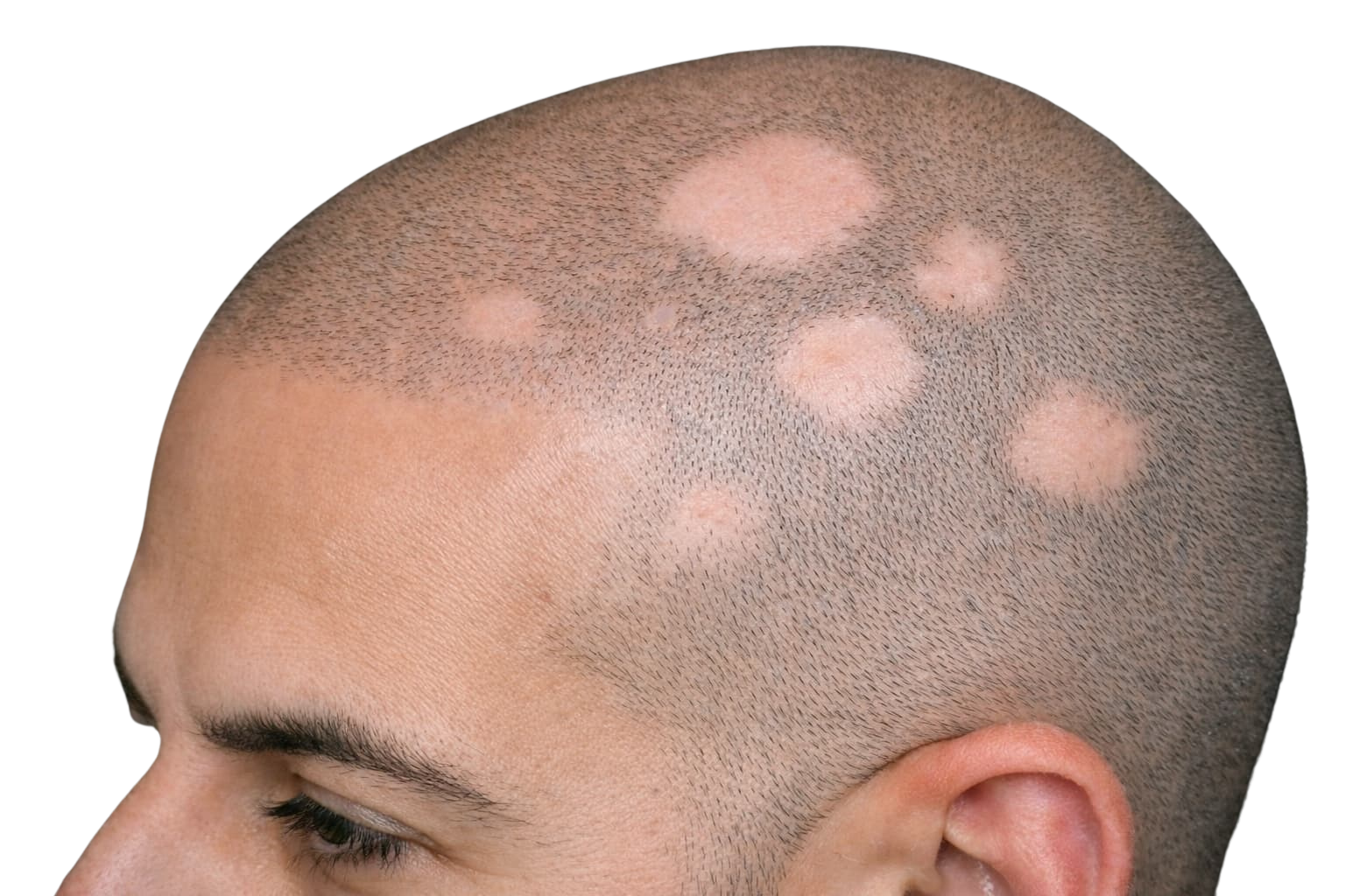 Scar camouflage & alopecia