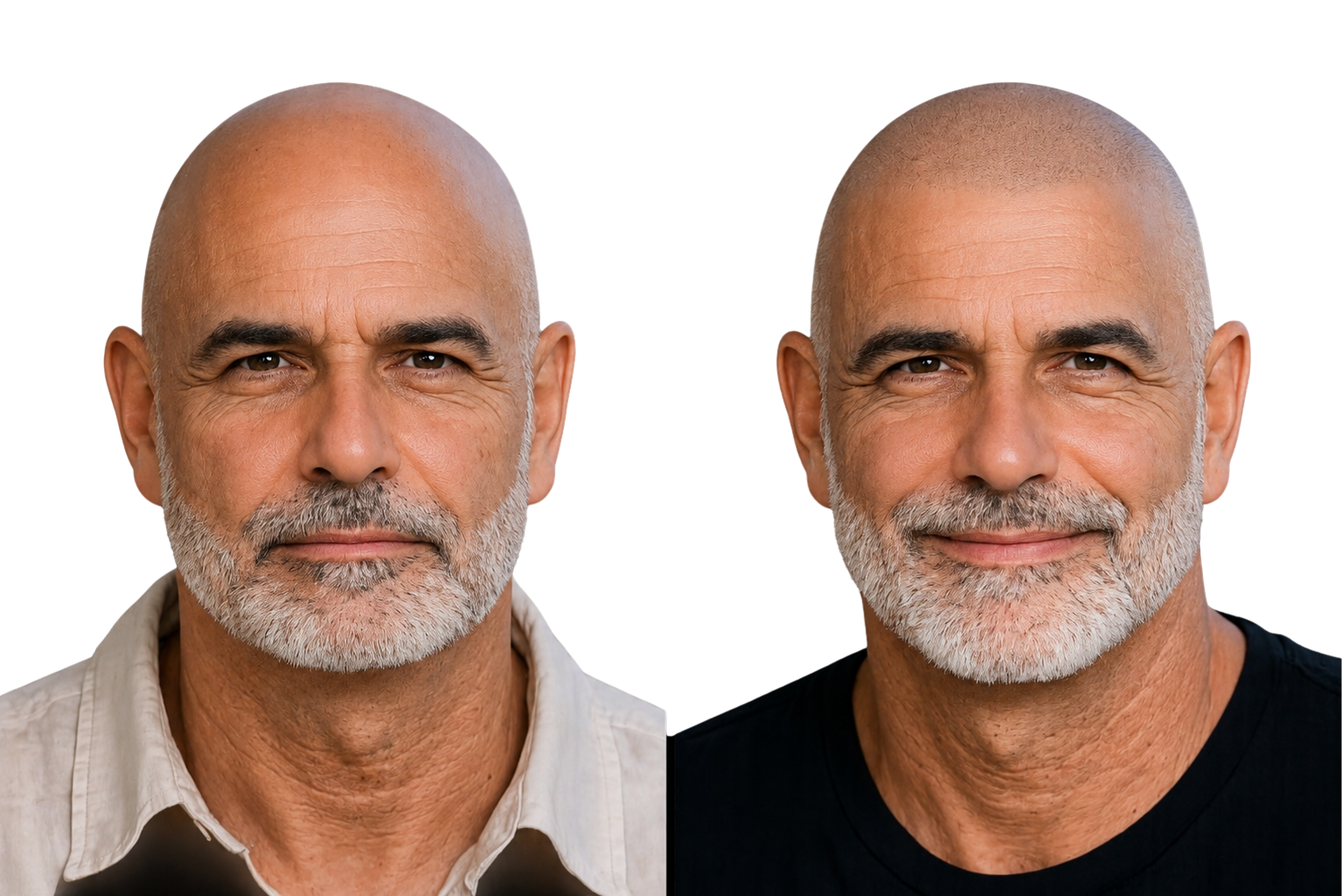 Before and after SMP softening the hairline of a mature client