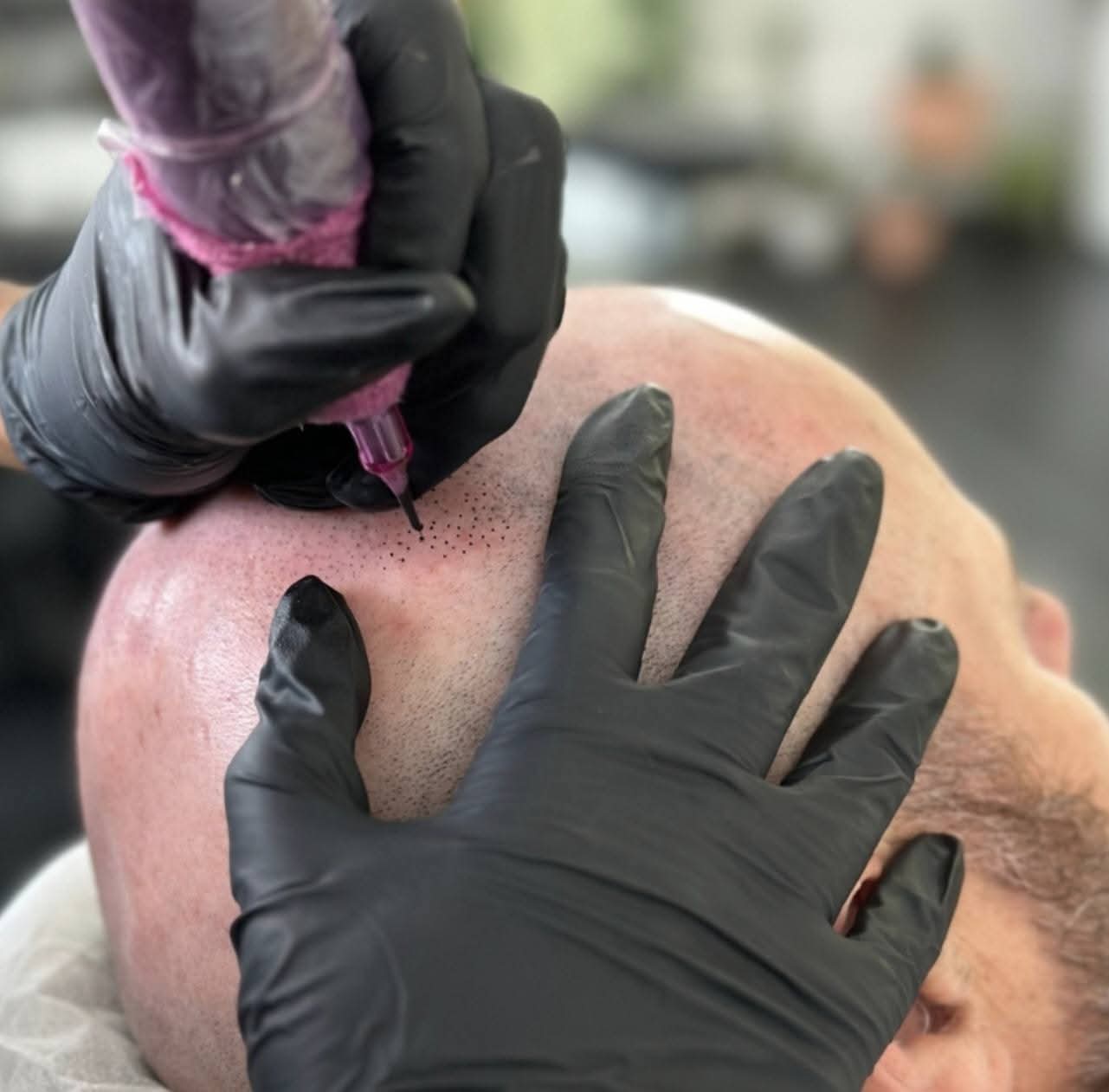 Bonnie completing a scalp micropigmentation treatment