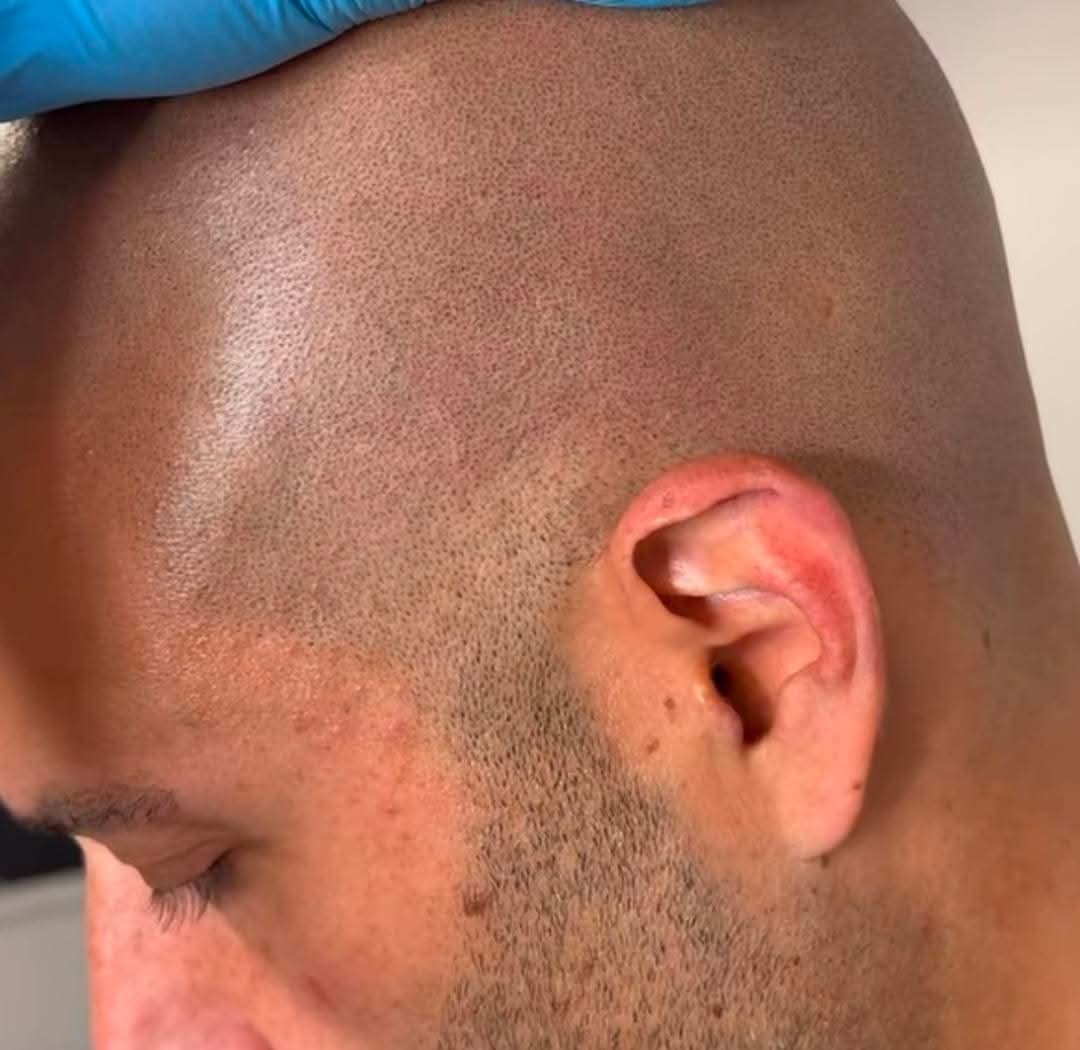 Close detail of scalp micropigmentation follicle impressions